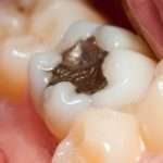 amalgama dentale e sclerosi multipla