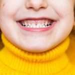 malocclusione dentale nei bambini