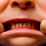 ipomineralizzazione dei denti
